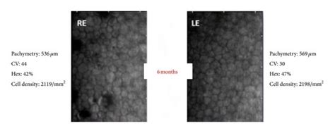 Specular microscopy of the RE shows polymegathism and pleomorphism; CV ...