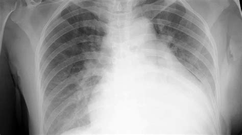 Pulmonary Edema Chf Chest X Ray