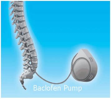 Physiotherapy JOBS: Baclofen Pump combined with Physiotherapy is a Life ...