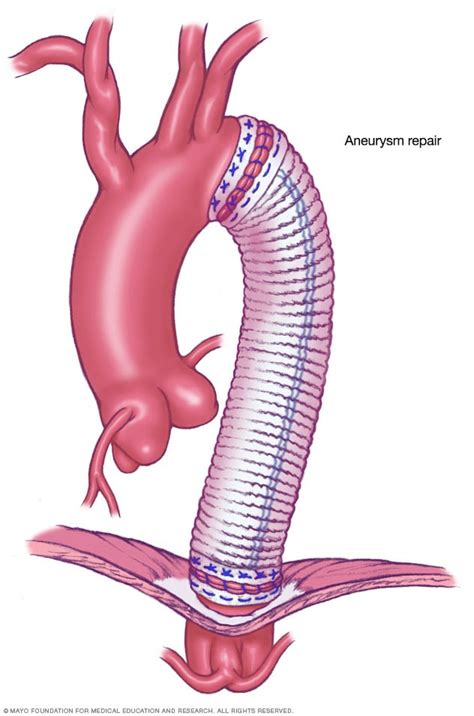 Thoracic aortic aneurysm - Diagnosis and treatment - Mayo Clinic