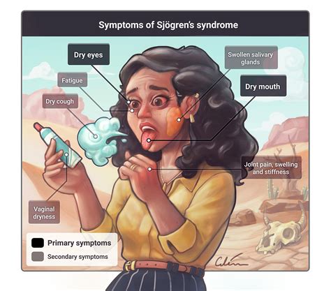 Sjögren's syndrome illustrated — artibiotics