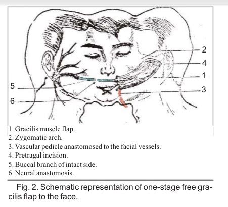 Gracilis Muscle Flap - Free Gracilis Muscle Transfer For Facial Paralysis