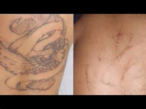 Dermabrasion Still Effective, Still Valid For Tattoo Removal! - YouTube