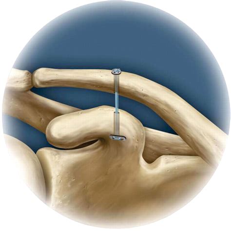 Biomechanics and treatment of acromioclavicular and sternoclavicular ...