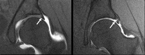 MRI and Hip Labral Tear - Robert Howells