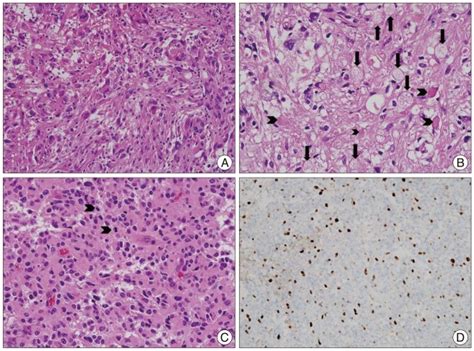 Histological features of pleomorphic xanthoastrocytoma (PXA). A ...