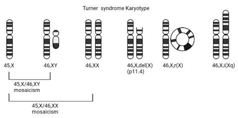 Turner Syndrome Diagram