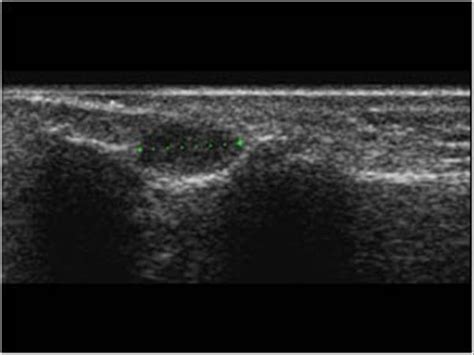 Musculoskeletal Joints and Tendons | 6.4 Fingers : Case 6.4.5 Tumors ...