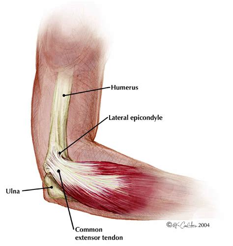 Lateral Epicondylitis (Tennis Elbow) - The Institute for Athletic Medicine