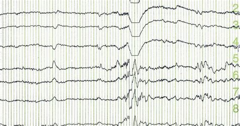 Understanding Your EEG Results | Normal & Abnormal EEGs