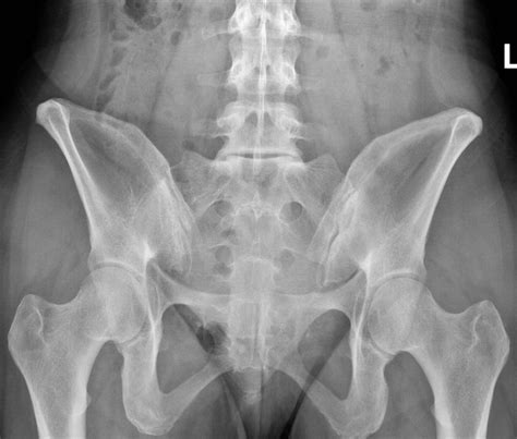 Sacral Dysmorphism and Lumbosacral Transitional Vertebrae (LSTV) Review ...