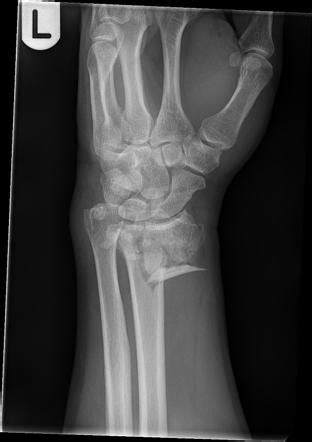 Compound Fractures X Ray