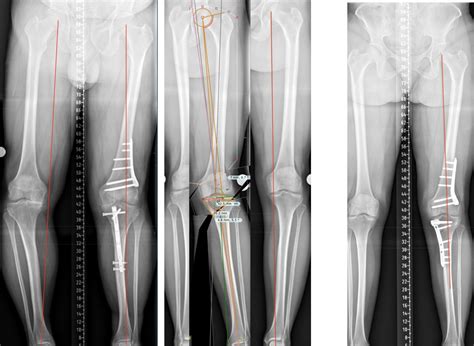 Osteotomy Surgery - Knee Surgery - Northern Knee Clinic