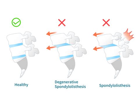 Types of Spondylolisthesis | PainScale