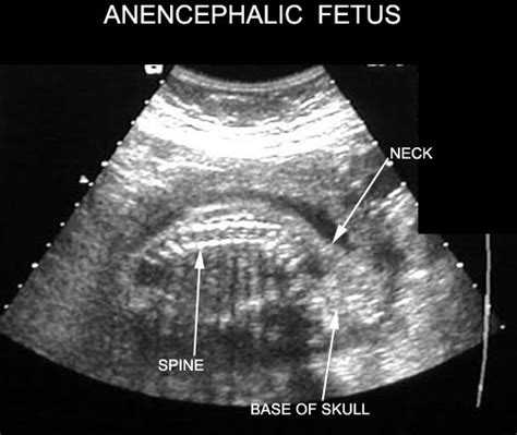 Anencephaly