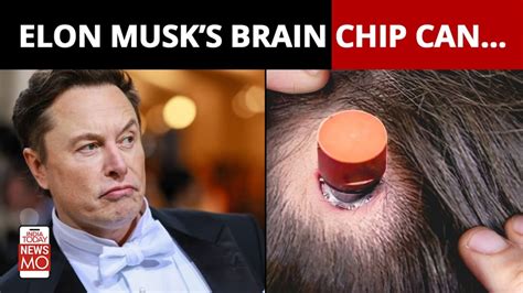 Elon Musk's Brain Chip Neuralink N1 Ready To Be Implanted in Humans ...