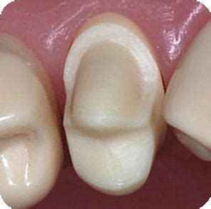 Indirect Restorations: Metal-Ceramic (PFM) Crown Prep. Upper 1st Premolar