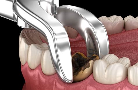 Tooth Extraction Cost for 2021, Procedure, Risks, & Recovery