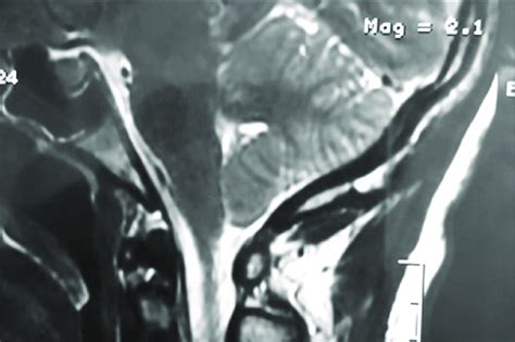 After performing a valveless lumboperitoneal shunt, the cerebral MRI in ...