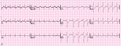 Ecg With Atrial Fibrillation