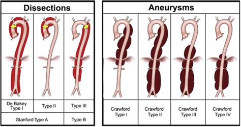 Thoracic Aortic Aneurysm - dlaczego-akurat-my