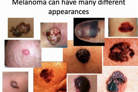 Stage IV Melanoma: Causes, symptoms & Treatments | Global Treatment ...