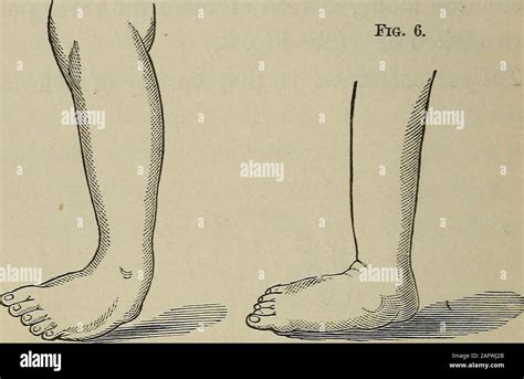 Varus club foot types 124441