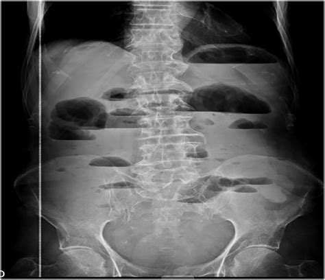 Abdominal plain X-ray film: an ileus pattern with distended small bowel ...