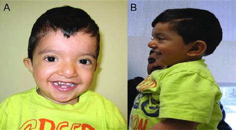 patient presenting with Noonan syndrome phenotype of short stature ...