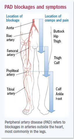 Peripheral Arterial Disease - Harvard Health