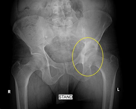 Osteoblastoma Spine