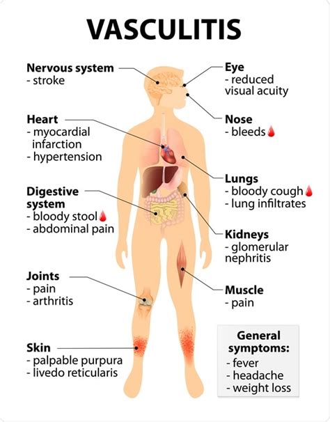 Prednisone For Vasculitis