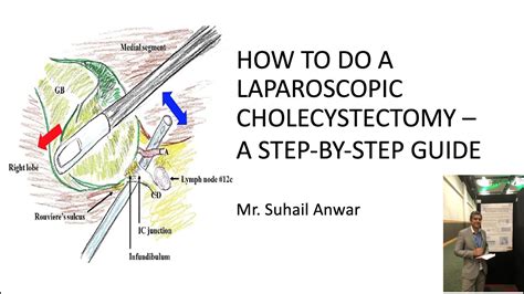 How to do a laparoscopic cholecystectomy- A step by step guide. Mr ...