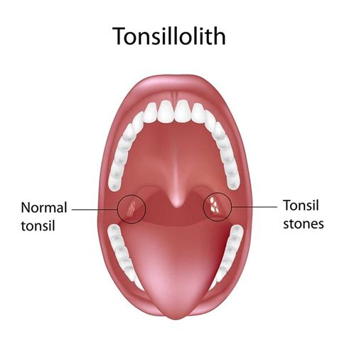 What Causes Tonsil Stones: Symptoms & Removal