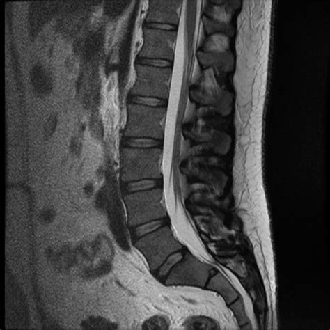 Mri Lumbar Spine Anatomy - Anatomy Reading Source