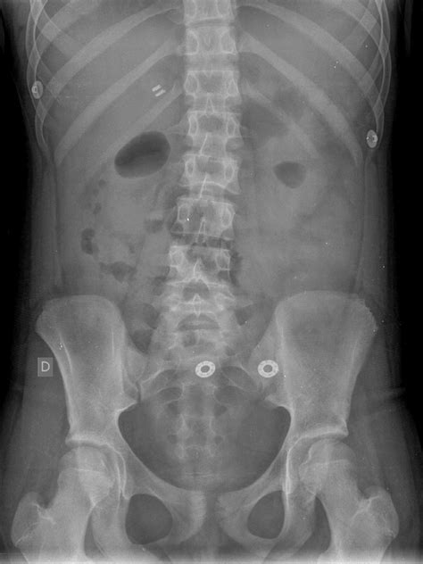 -Abdominal radiography. Dorsal decubitus view. | Download Scientific ...