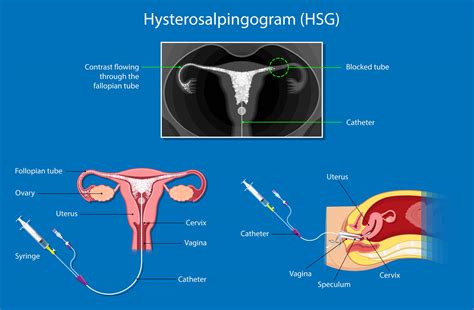 Chances Of Getting Pregnant After Hysterosalpingogram (HSG )Test ...