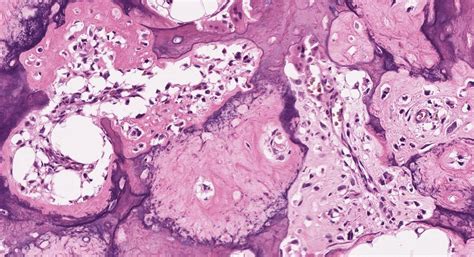 Histology Of Osteosarcoma