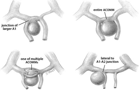 Aneurysms of the Anterior Communicating Artery | Neupsy Key