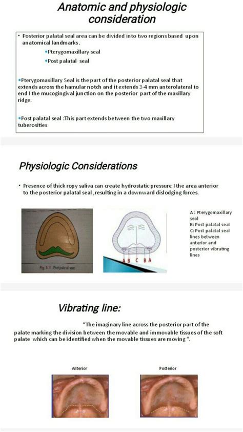 POSTERIOR PAlATAL SEAL AREA(PPS) | Seal, Restorative dentistry, Dentistry