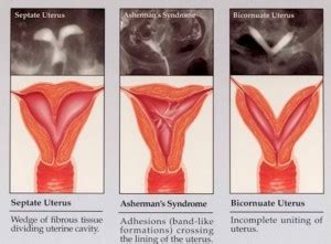 Uterine Septum - Infertility Causes - Dallas - Frisco Fertility - Center