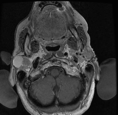 Pleomorphic adenoma - wikidoc