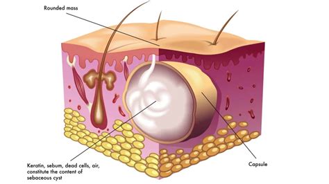 Sebaceous Cyst Removal