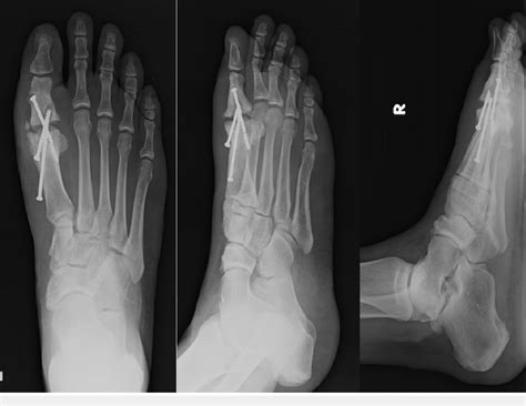 Radiographs one year post arthrodesis | Download Scientific Diagram