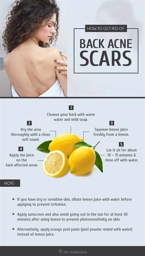 How to Get Rid of Back Acne Scars