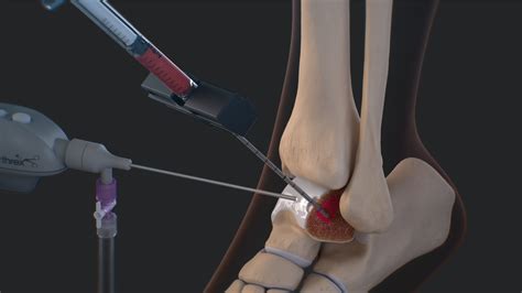 Arthrex - IntraOsseous BioPlasty® (IOBP) Technique for Treatment of ...