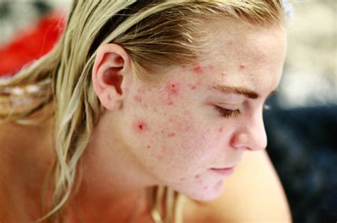 Acne a Skin Condition – Causes, Symptoms and Treatment