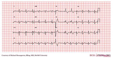 Supraventricular arrhythmias - wikidoc