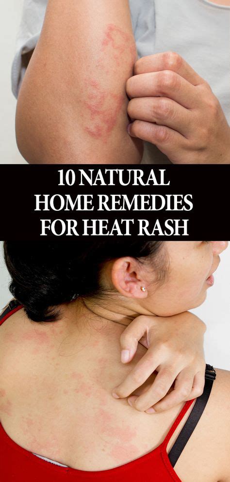 Heat Rash Symptoms And How To Treat It The New York Times - Riset