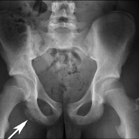 (PDF) A novel approach to treatment for chronic avulsion fracture of ...